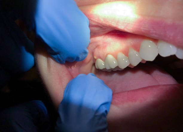 Best Emergency Dentist for Knocked-Out Tooth in Pantops, VA
