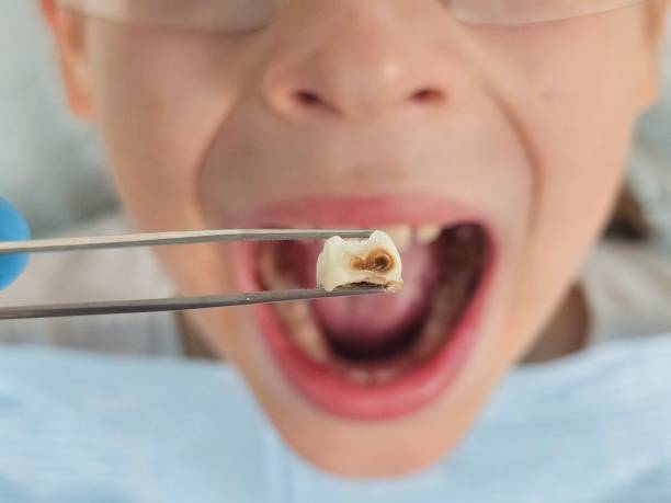 Best Emergency Dentist for Lost Fillings or Crowns in Pantops, VA