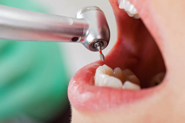 Best Emergency Dentist for Lost Fillings or Crowns in Pantops, VA